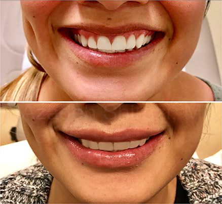Before & After Lip Rejuvenation