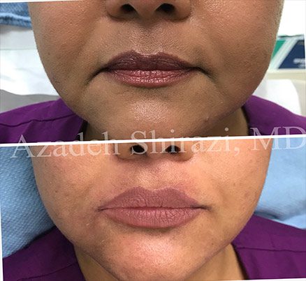 Woman's Lips Before & After Juvederm Filler