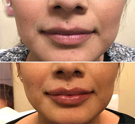 Woman Before & After Cosmetic Lip Filler