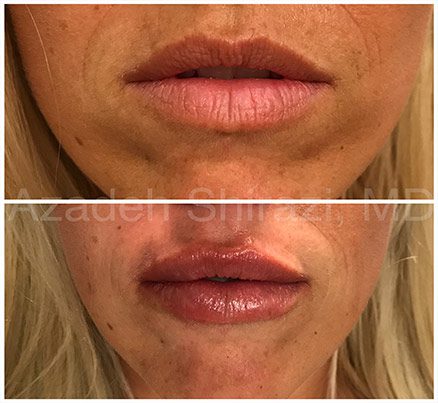 Woman's Lips Before Restylane Filler & After