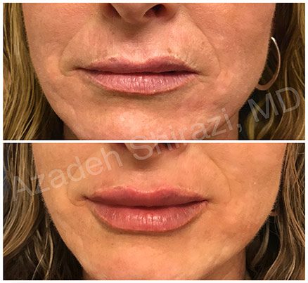 Woman Before & After Juvederm Filler