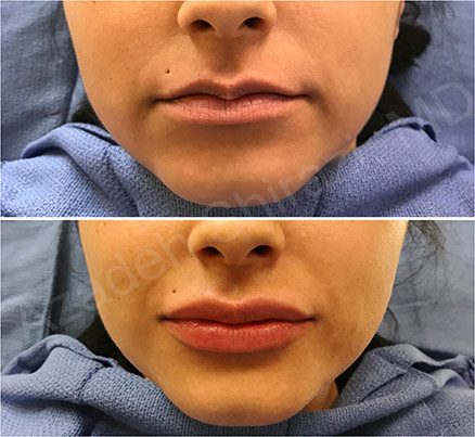 Before & After Juvederm Lip Filler