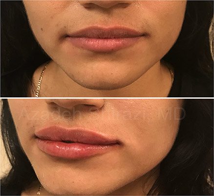 Before & After Results Of Restylane Filler