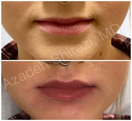 Lips Before & After Using Restylane Filler