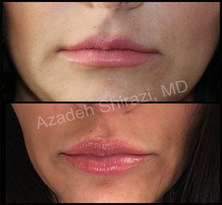 Before & After Restylane Lip Filler