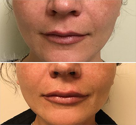 Woman Before & After Restylane Filler