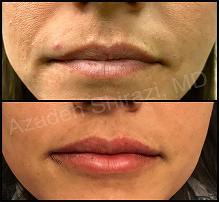 Woman's Lips Before & After Restylane