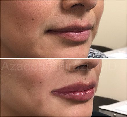 Before & After Results Of Restylane In Lips