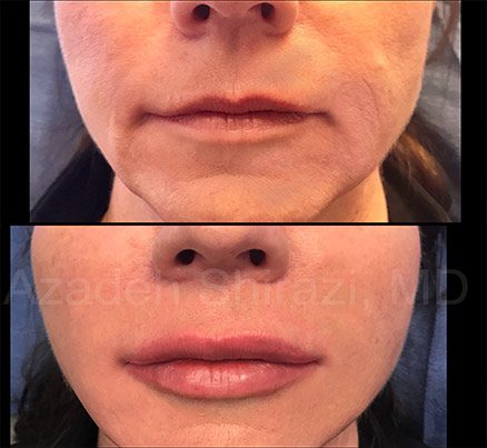 Woman Before & After Lip Fat Grafting Filler