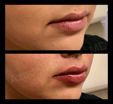 Before & After Fat Grafting Lip Filler