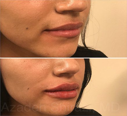 Juvederm Filler Before & After