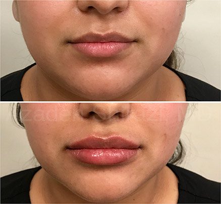 Before & After Restylane Filler On Lips