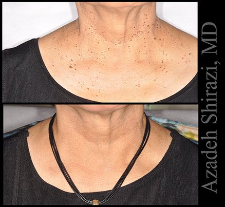 Neck Before & After Skin Growth Removal