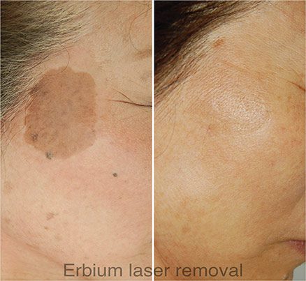 Face Before & After Erbium Laser Removal