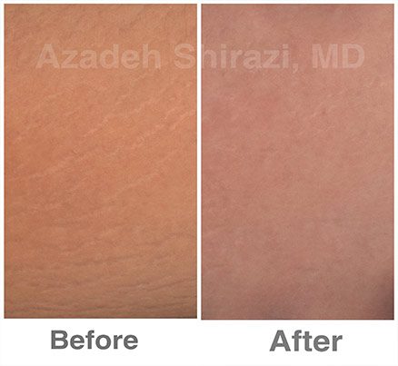 Before And After Stretch Mark Treatment