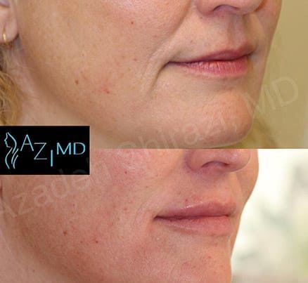 Woman's Lower Face Before & After Fillers