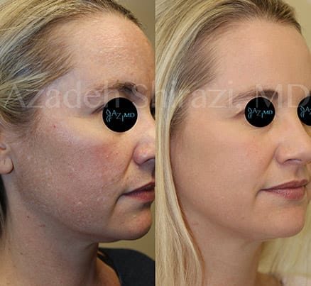 Woman Before & After Photorejuvenation Therapy On Face