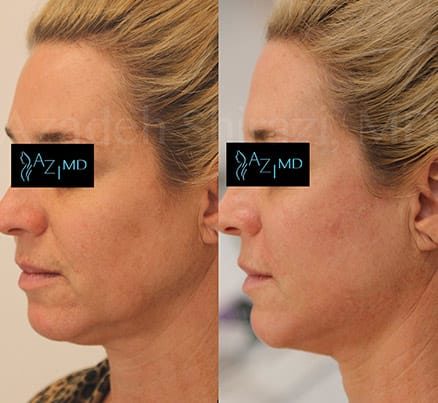 Woman Before & After Chin Augmentation Filler