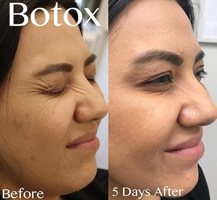 Before & After Results Of Botox