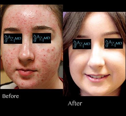 Girl Before & After Diamond Glow For Acne Treatment