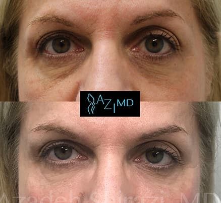 Woman Before & After EyeGlow Eye Rejuvenation