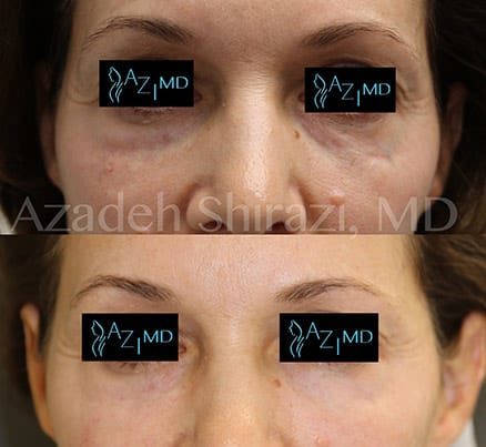 Woman's Face Before & After Eye Rejuvenation Treatment