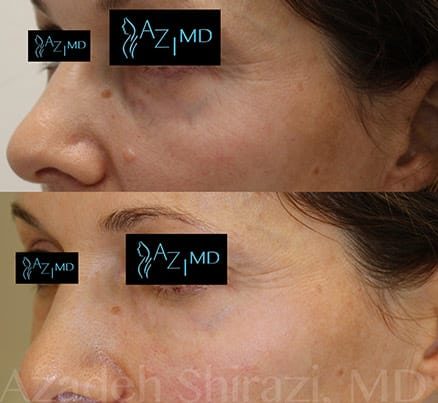 Before & After EyeGlow Eye Rejuvenation