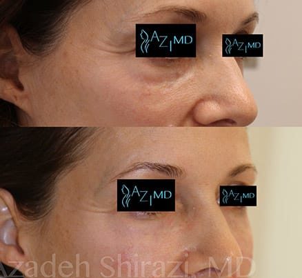 Before & After Results Of EyeGlow Eye Rejuvenation