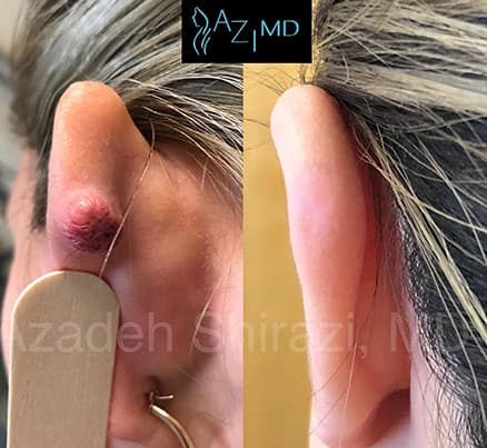 Before & After Mole Removal On Ear