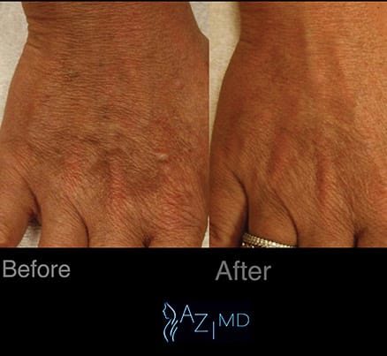 Before & After Hand Rejuvenation