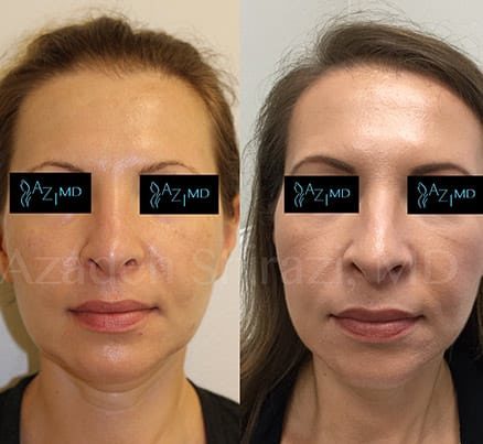 Lady Before & After Chin Augmentation Filler