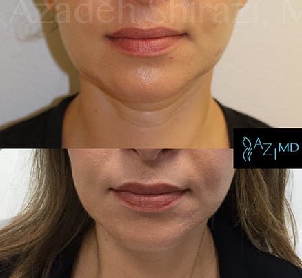Woman Before & After Non Surgical Augmentation
