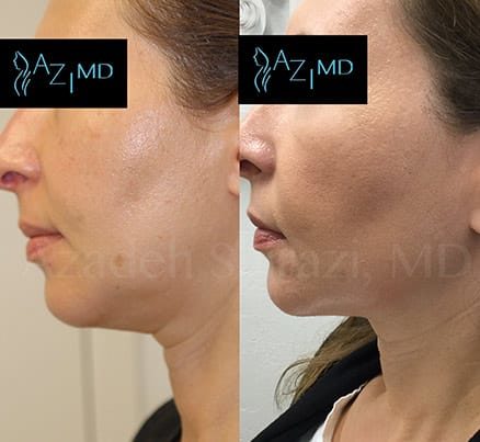 Before & After Non Surgical Chin Augmentation
