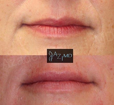 Lips Before & After Lip Filler Treatment
