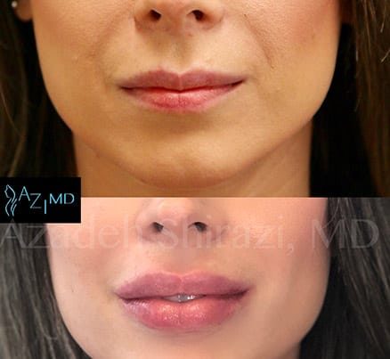 Before & After Lip Filler Rejuvenation