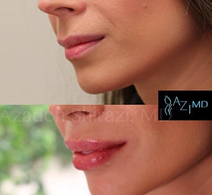 Woman Before & After Lip Filler Treatment