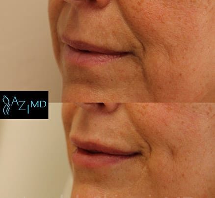 Before & After Lip Rejuvenation Fillers