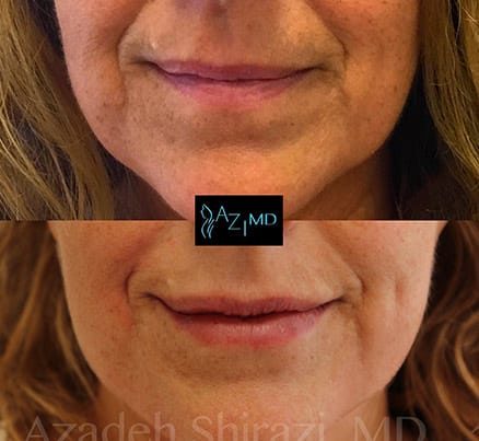 Woman's Lips Before & After Lip Rejuvenation Filler