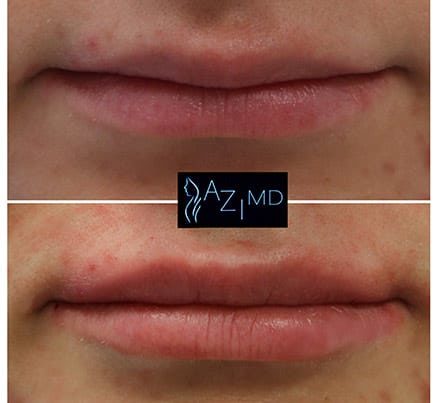 Lips Before & After Lip Threading