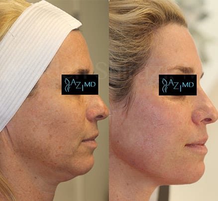 Profile Of Woman Before & After Liquid Face Lift For Jowls