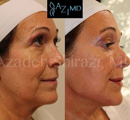 Profile Of Woman Before & After EyeGlow Eye Rejuvenation