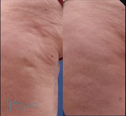 Legs Before & After Cellulite Laser Treatment