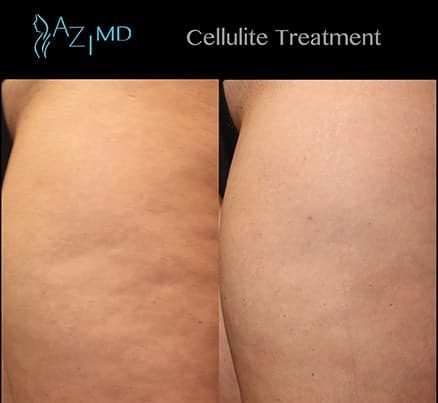 Before & After Cellulite Laser Treatment