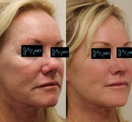 Before & After SkinLIFT Facial Treatment