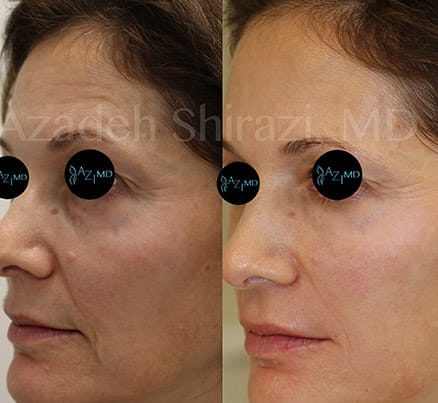 Woman's Face Before & After SkinLIFT