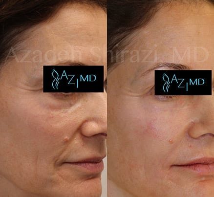 Woman After SkinLIFT Face Treatment