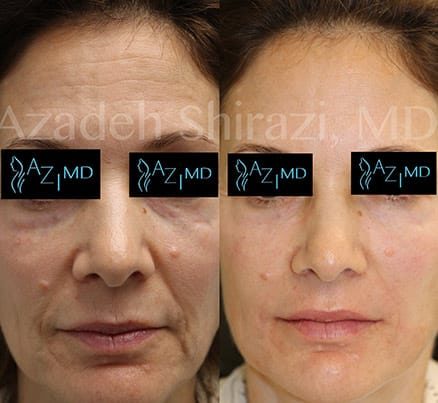 Before & After Of Laser Face Lift