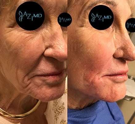 Woman Before & After SkinLift For Face