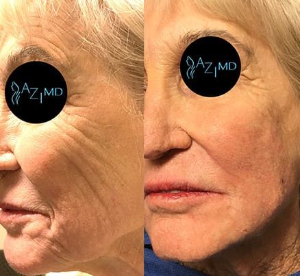 Older Woman Before & After Face Lift For Jowls