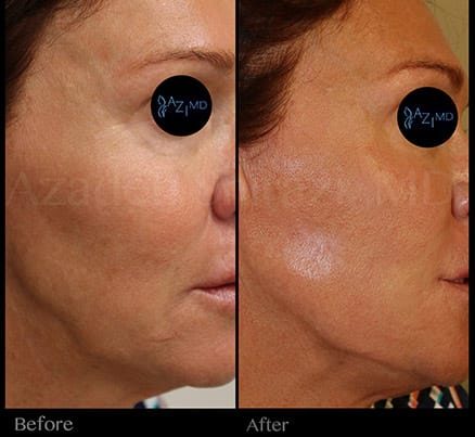 Woman Before & After Liquid Face Lift For Jowls